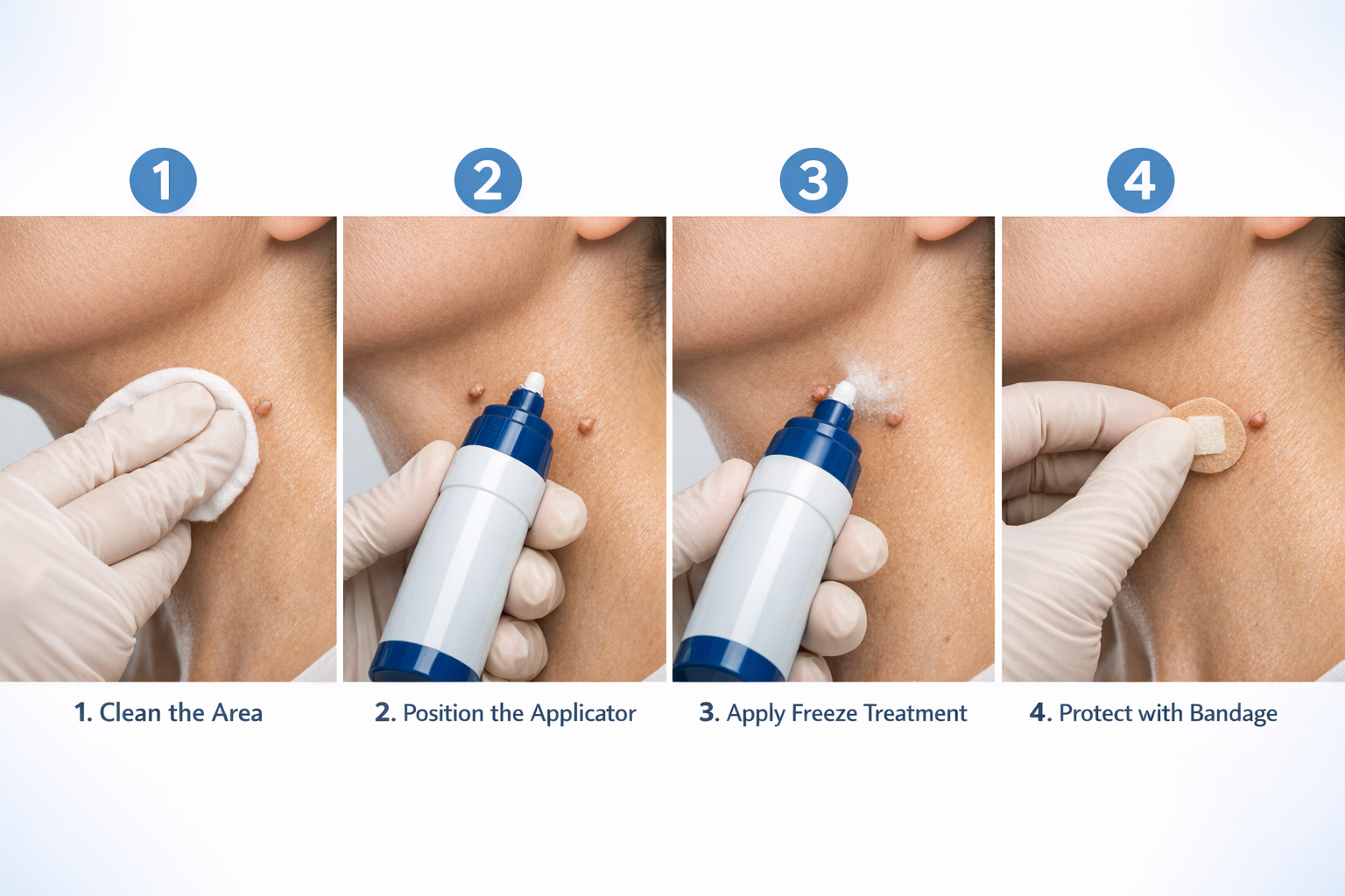 Detailed () close-up step-by-step process illustration showing hands carefully applying a cryotherapy skin tag removal