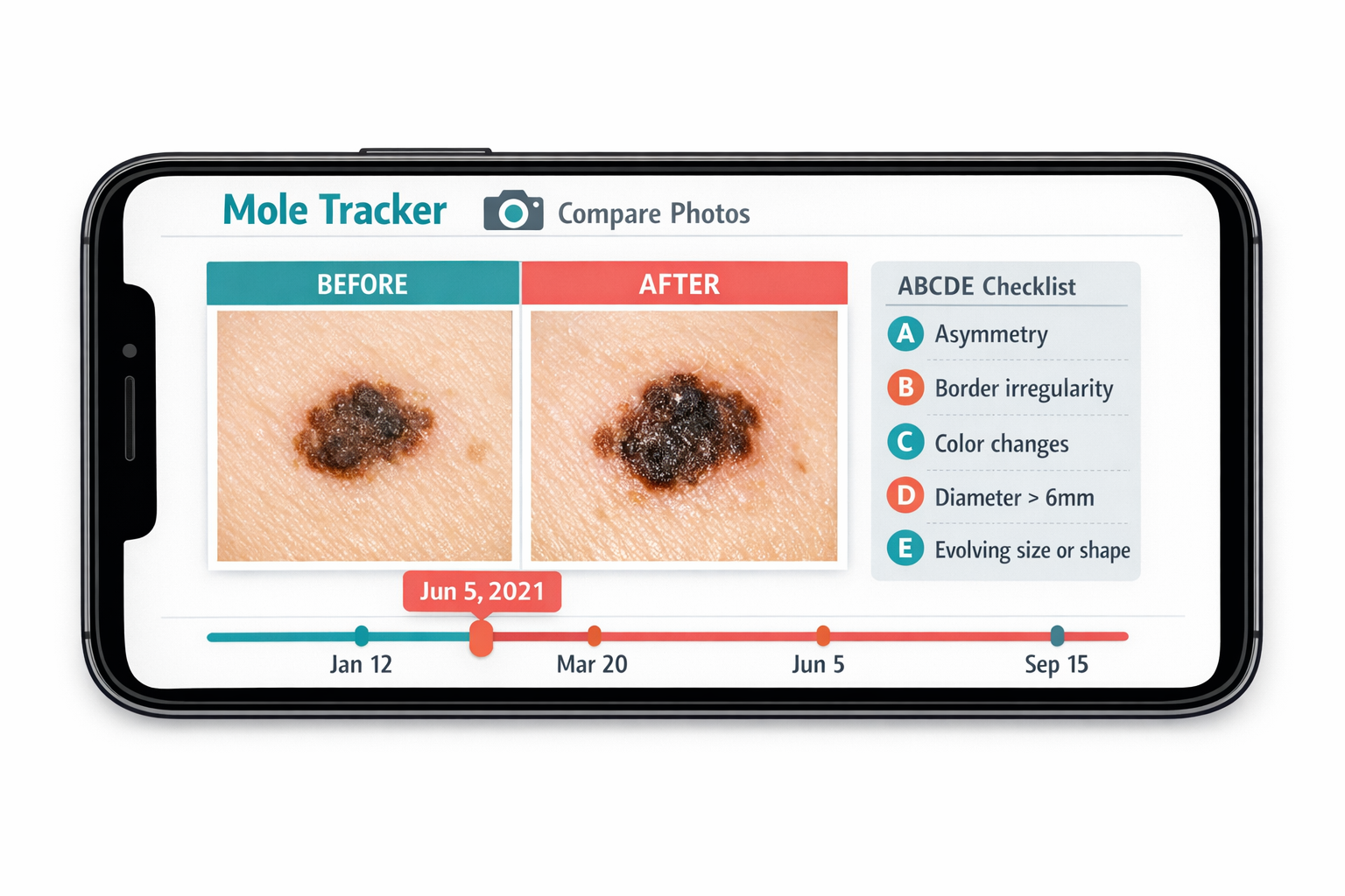 () editorial illustration showing a smartphone screen displaying a mole tracking app interface with labeled photo comparison